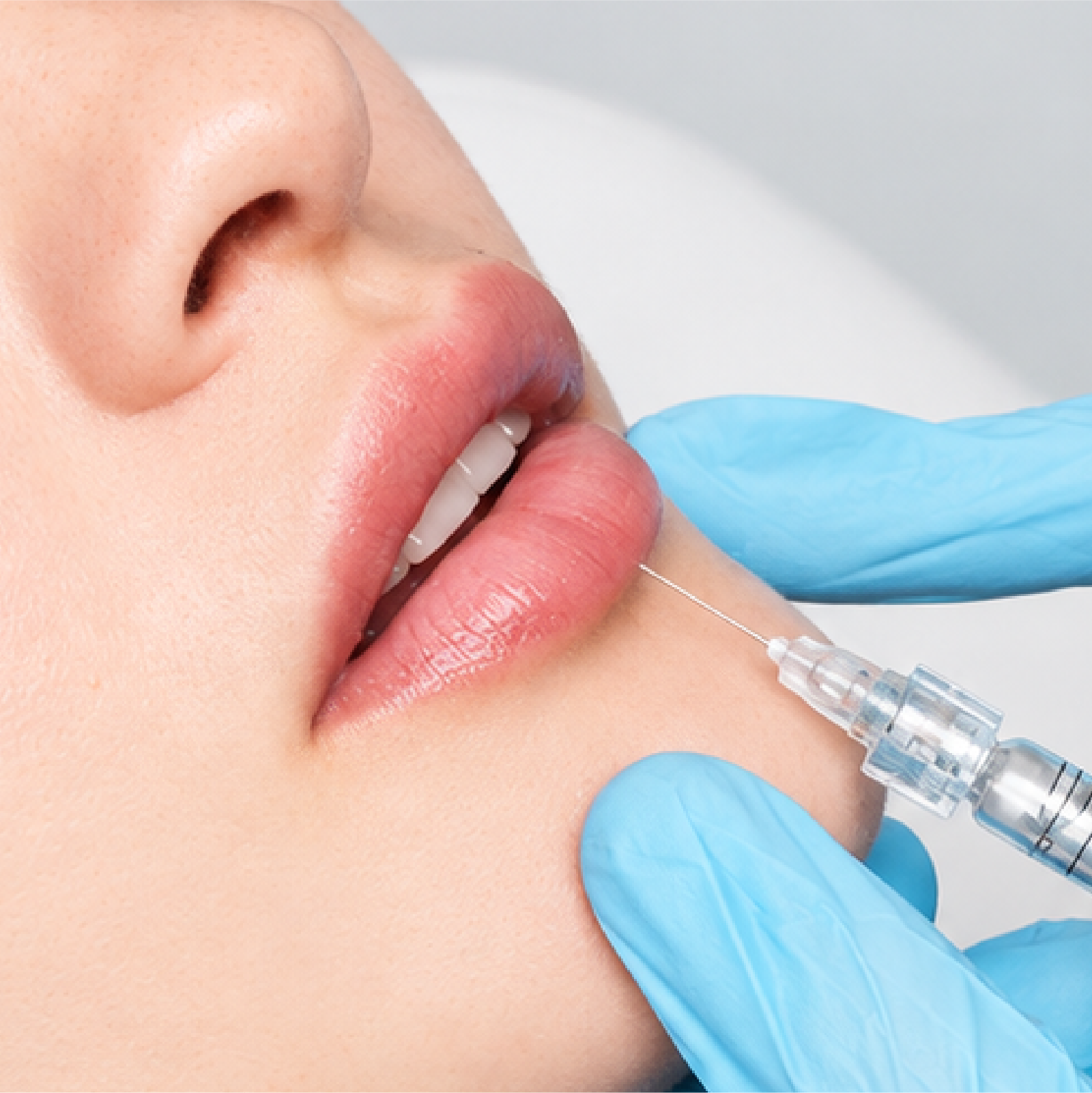 HA lip filler treatment at Vera Aesthetics Cambodia